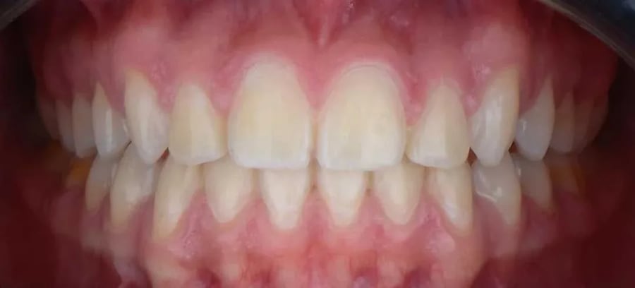 Case 2 after braces treatment in Dubai