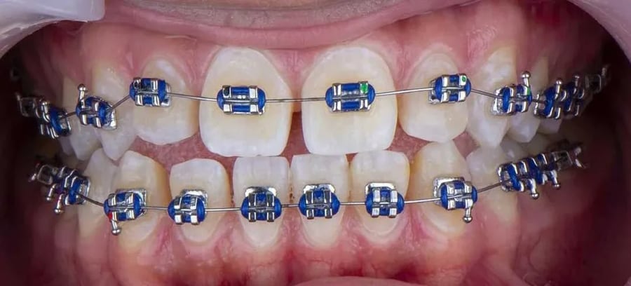 Case 2 before braces treatment in Dubai