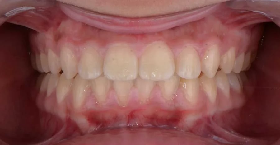 Case 3 after braces treatment in Dubai
