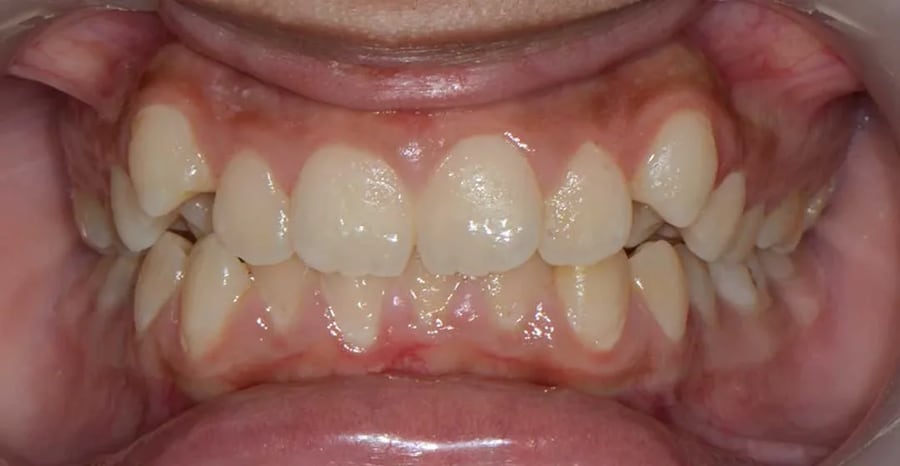 Case 3 before braces treatment in Dubai