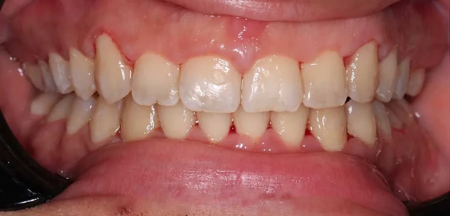 Case 6 after braces treatment in Dubai