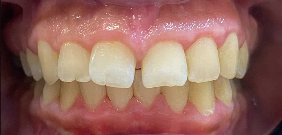 Case 6 before braces treatment in Dubai