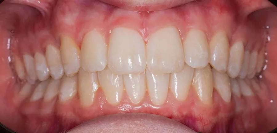 Case 5 after braces treatment in Dubai
