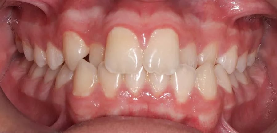 Case 5 before braces treatment in Dubai