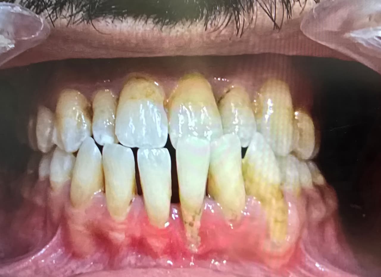 After veneers treatment