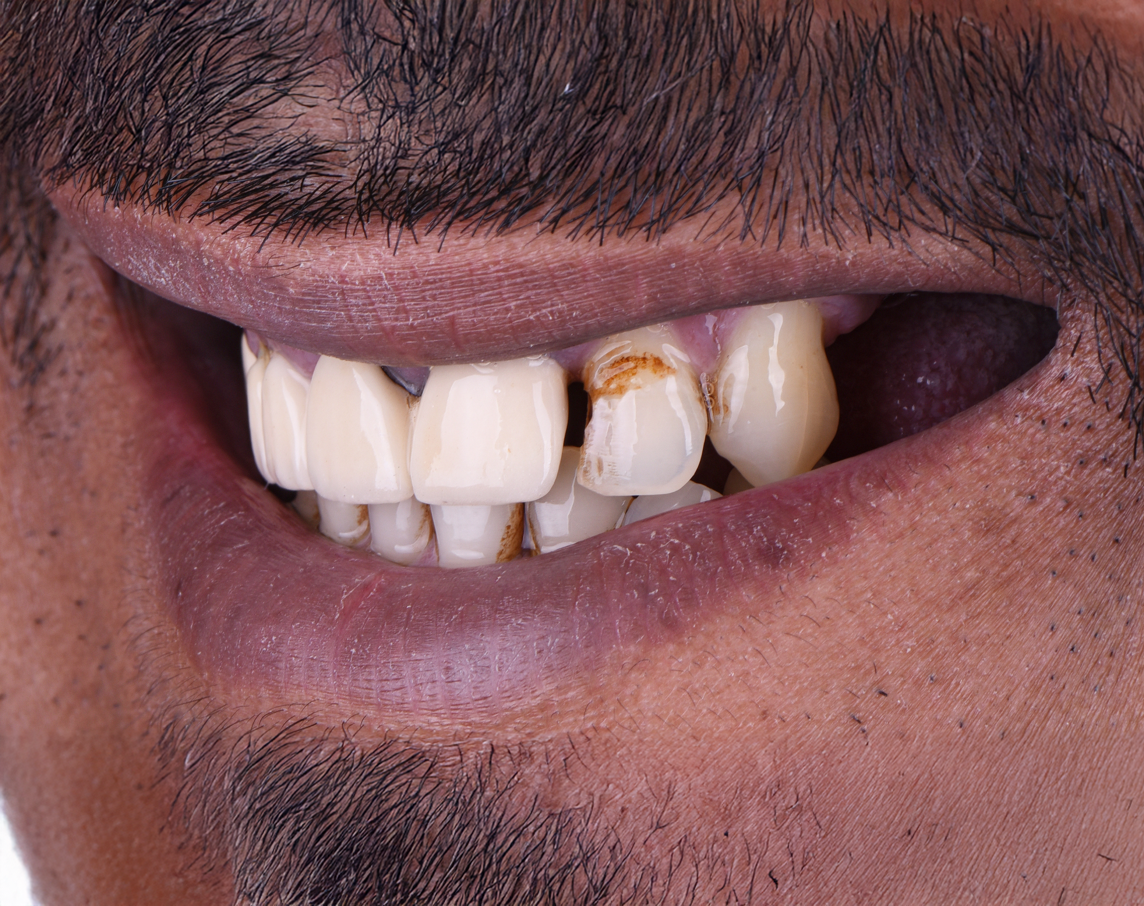 Before veneers treatment