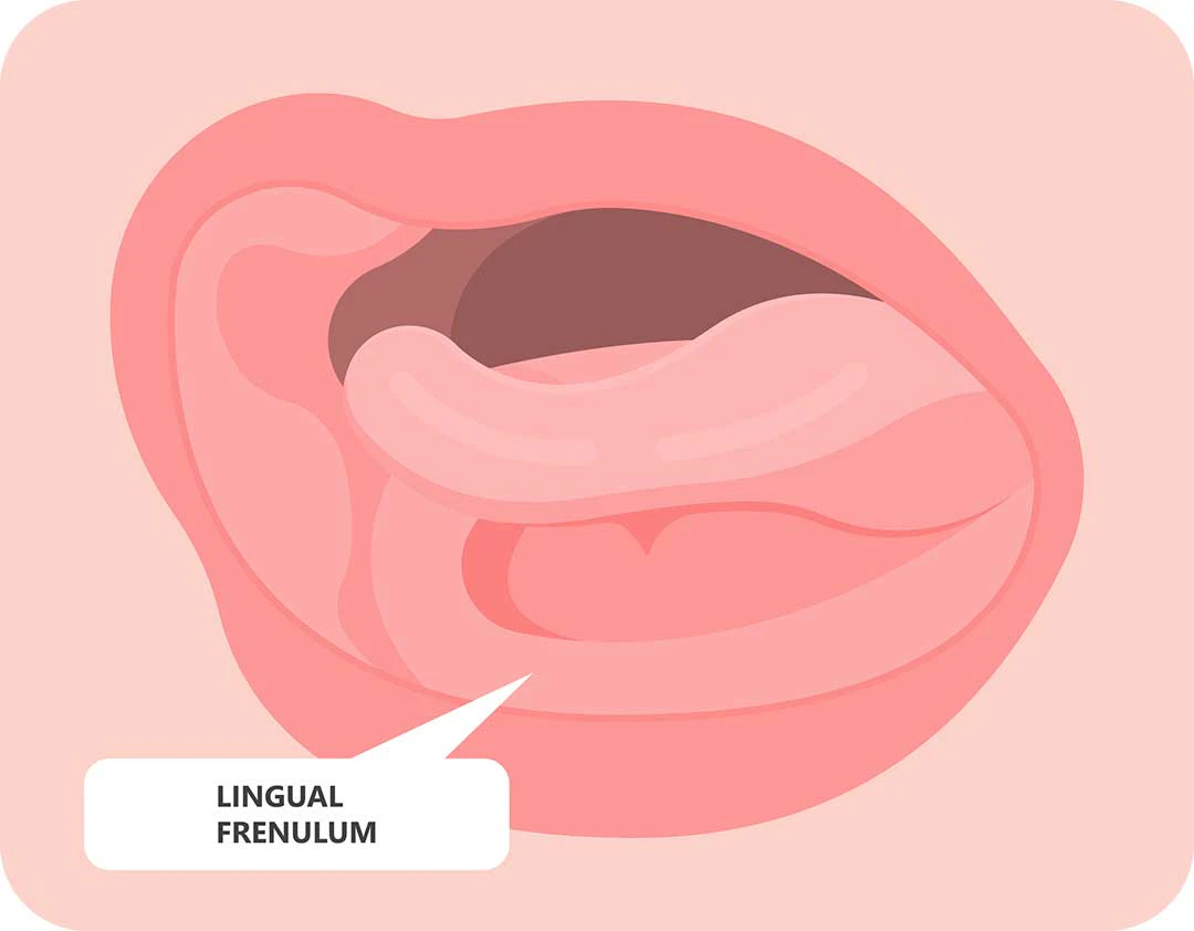 image of lingual frenectum