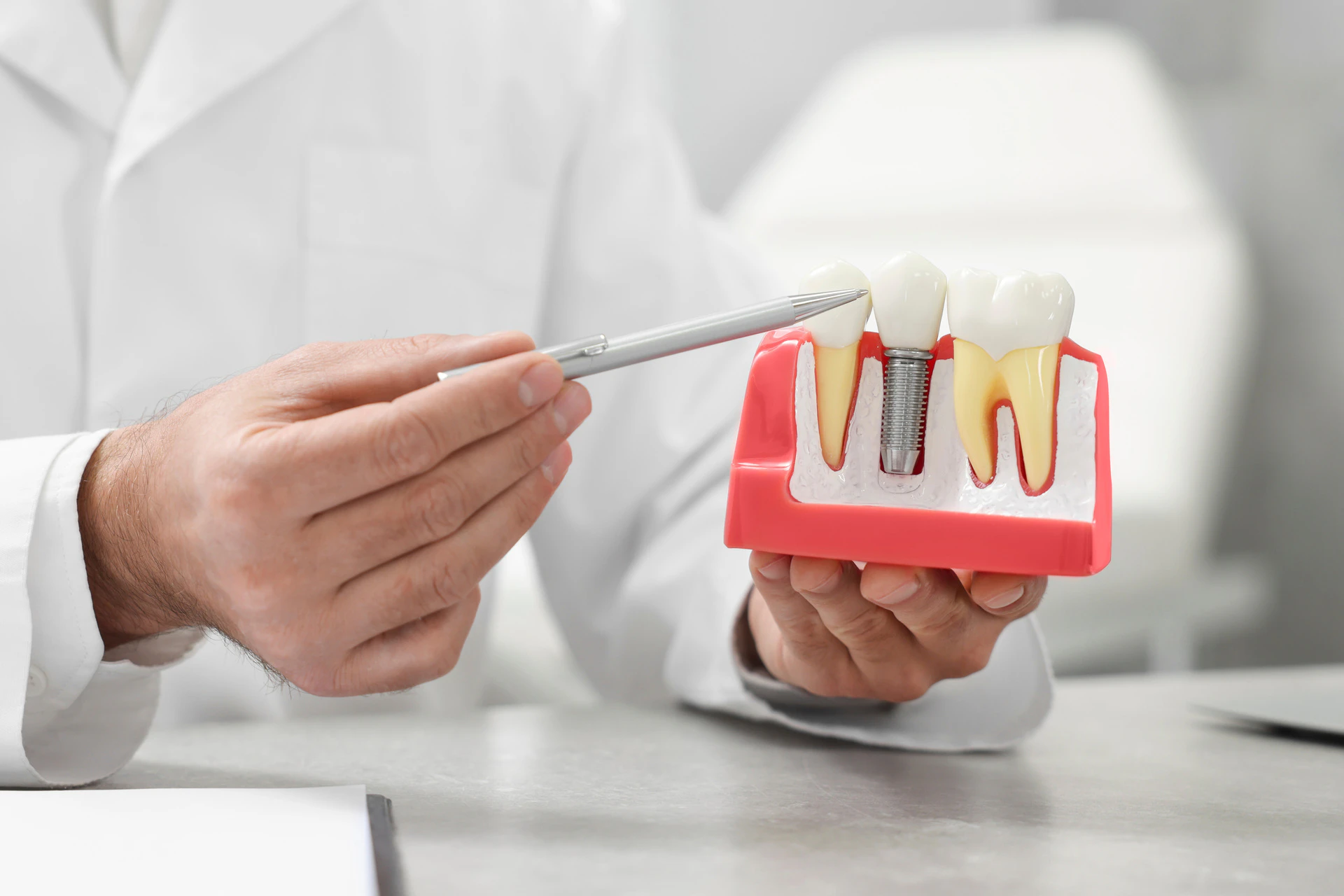 What Are Dental Implants? Surgery, Types, Purpose, and Benefits