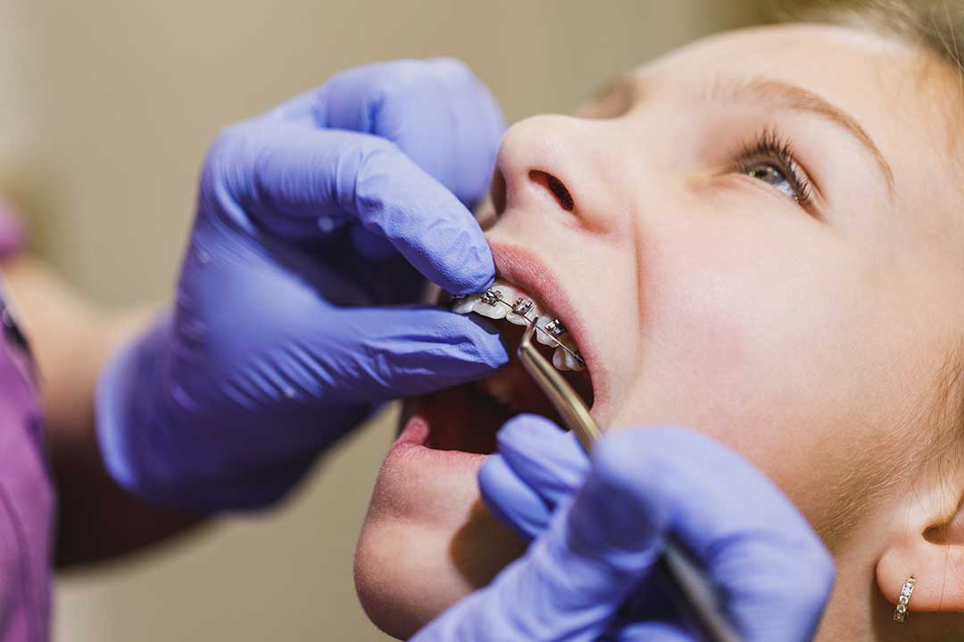 How do I know if my child really needs braces?