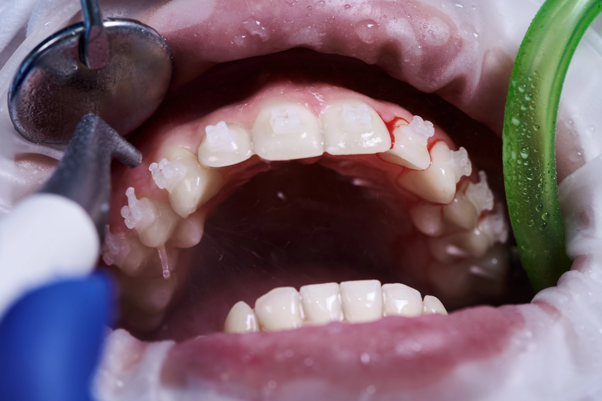 10 Natural Ways on How to Remove Tartar From Teeth