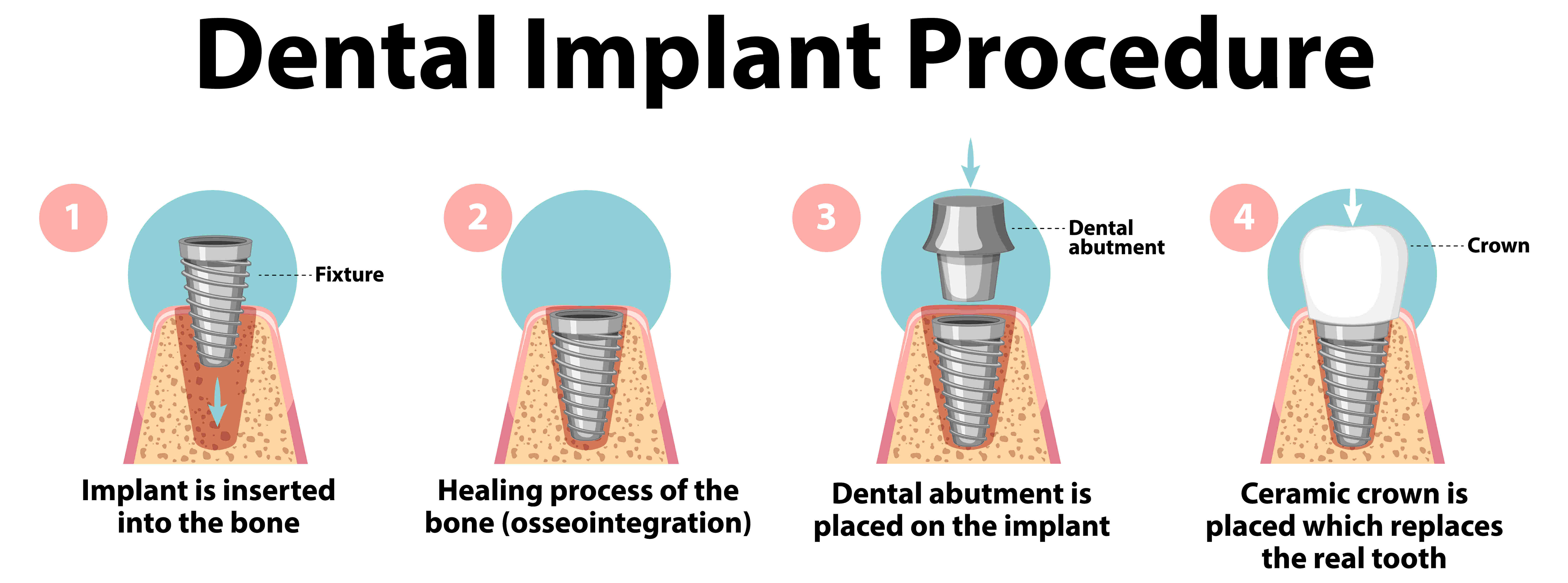 Dental Implants Surgery - Step by step