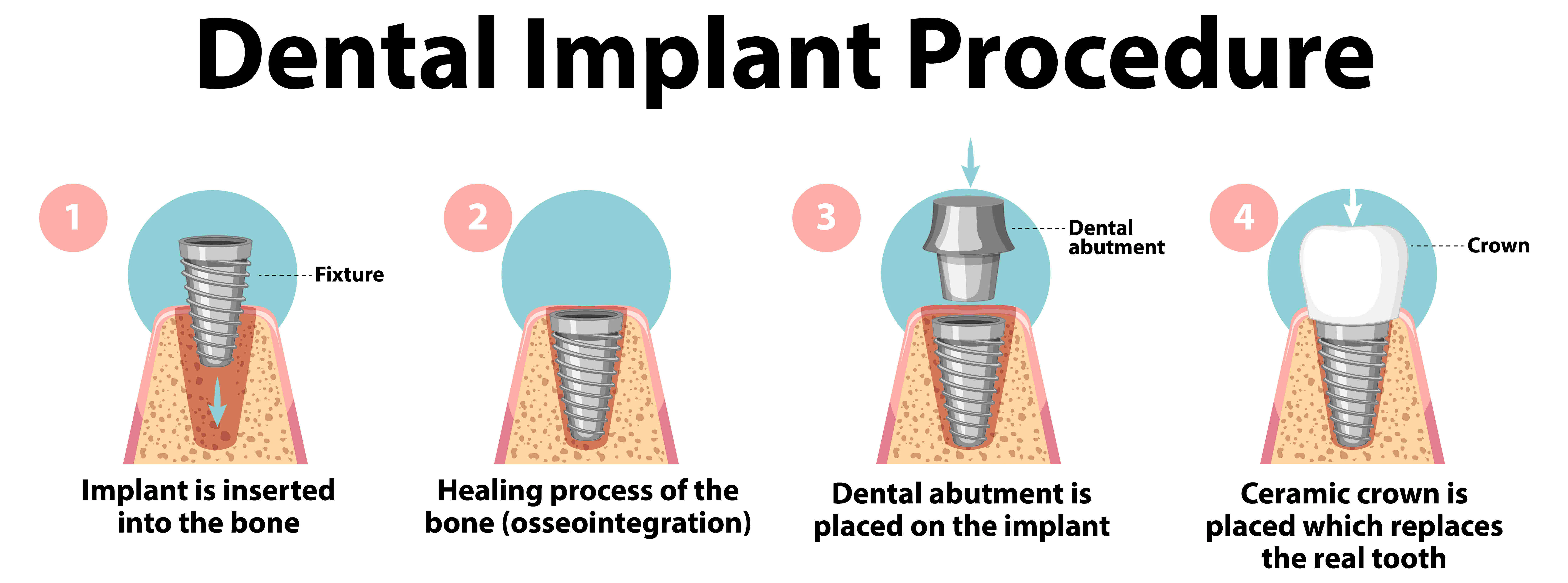 Dental Implants Surgery - Step by step