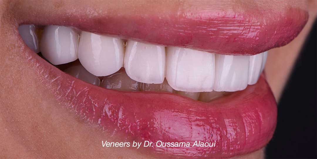Veneer Replacement: Get the Smile You Deserve