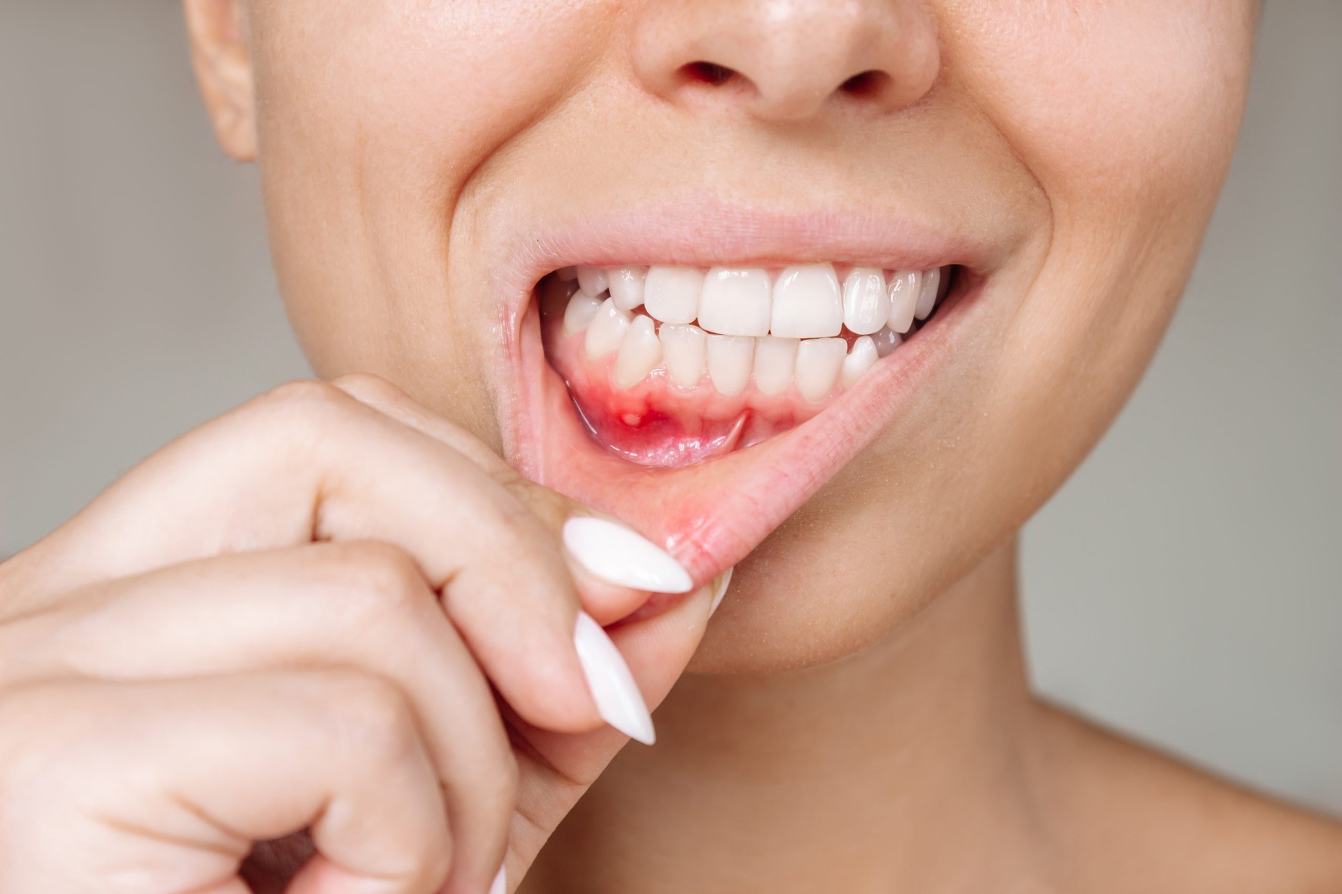 Periodontal Disease (Gum Disease): Causes & Symptoms