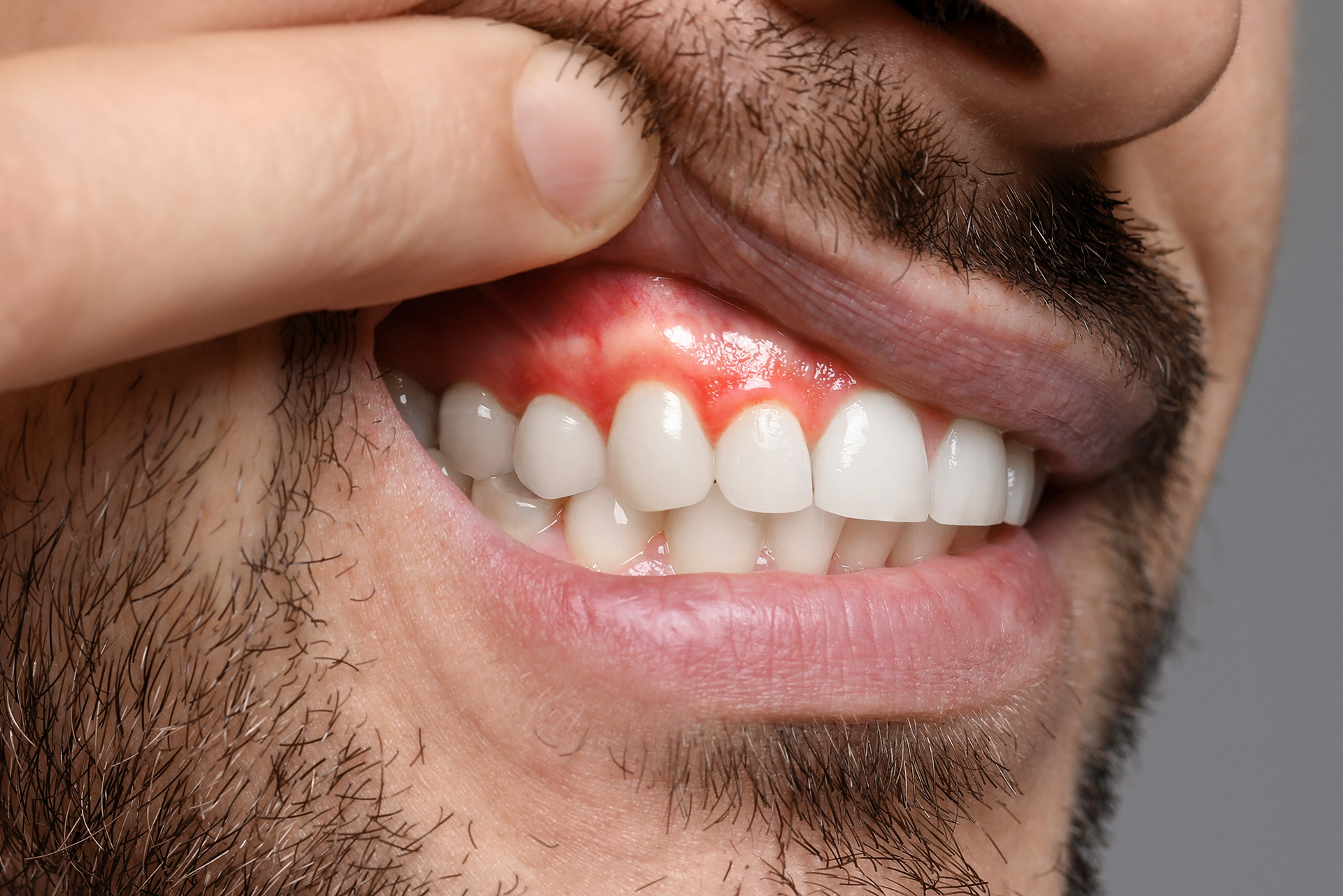 What are Gum Diseases and How to Prevent it?