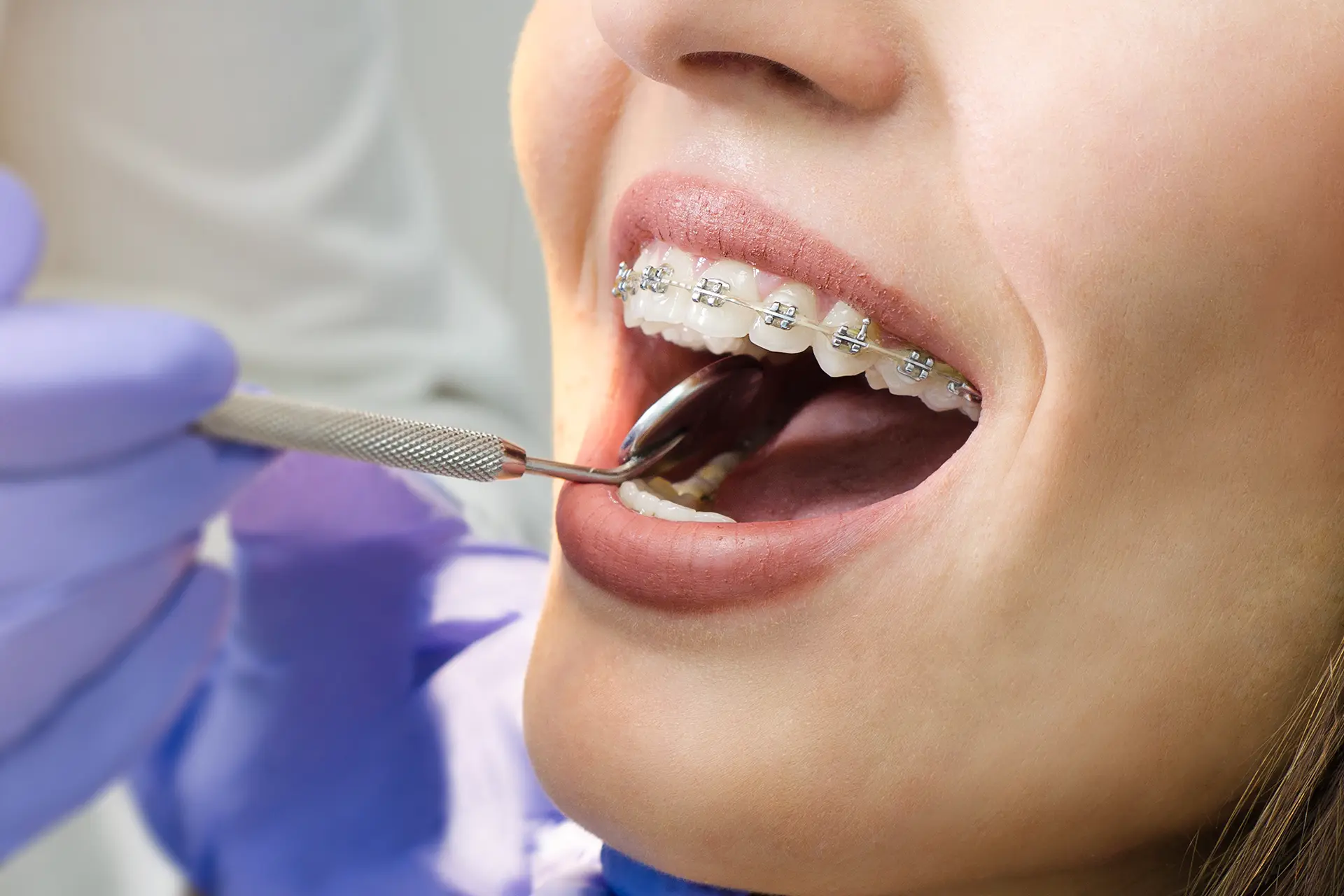 What are Teeth Braces: Types & How They Work