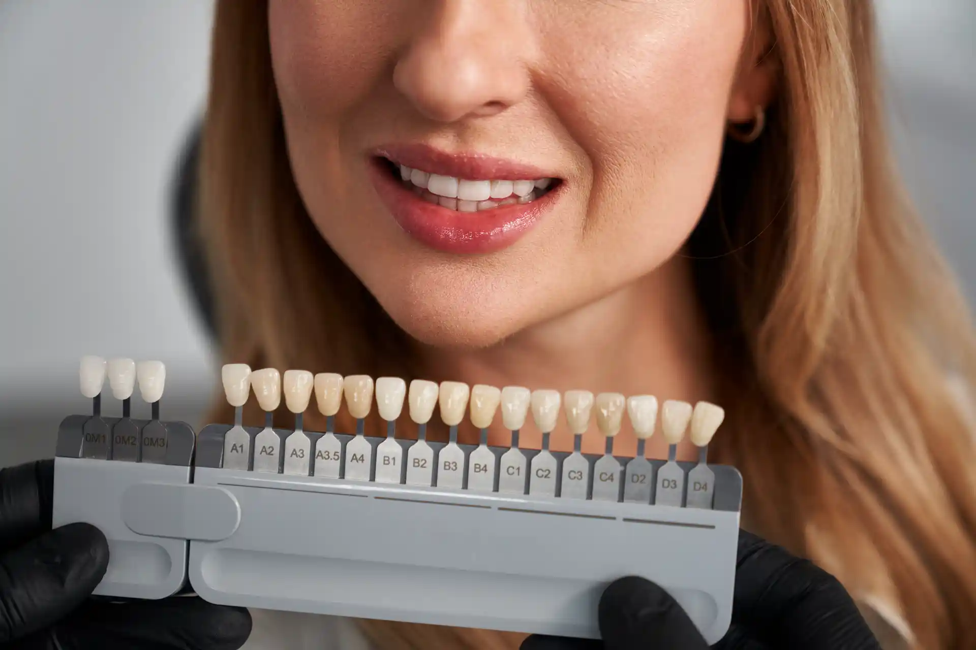 What Is a Feldspathic Veneer? Veneers Near Me