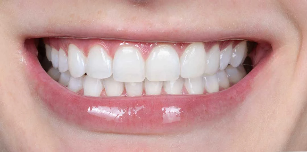 After in-office teeth whitening and Guided Biofilm Therapy