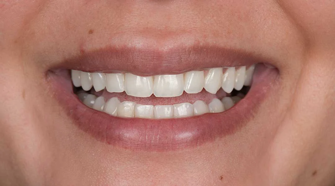 Before teeth whitening treatment and Guided Biofilm Therapy at Harmony Medical Center