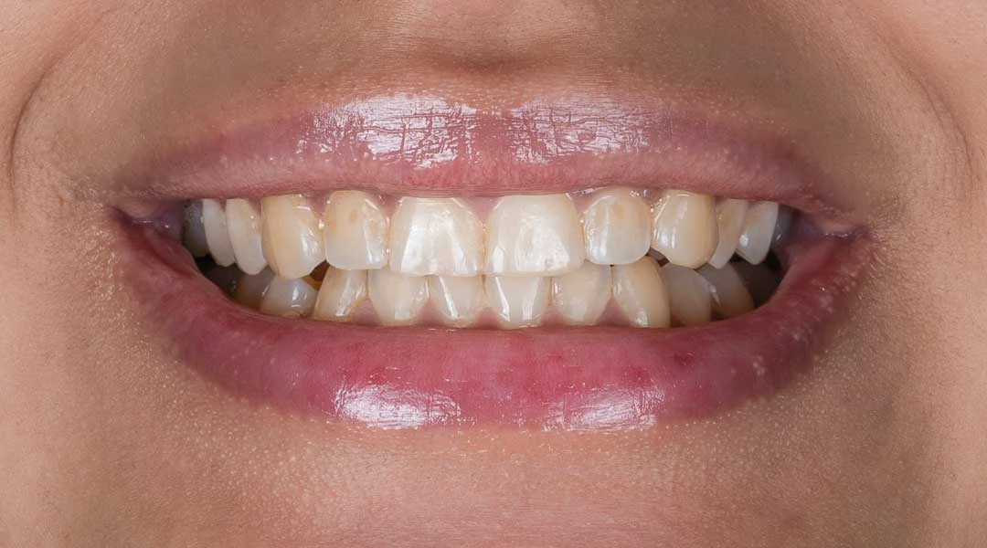 Before teeth whitening treatment and Guided Biofilm Therapy at Harmony Medical Center
