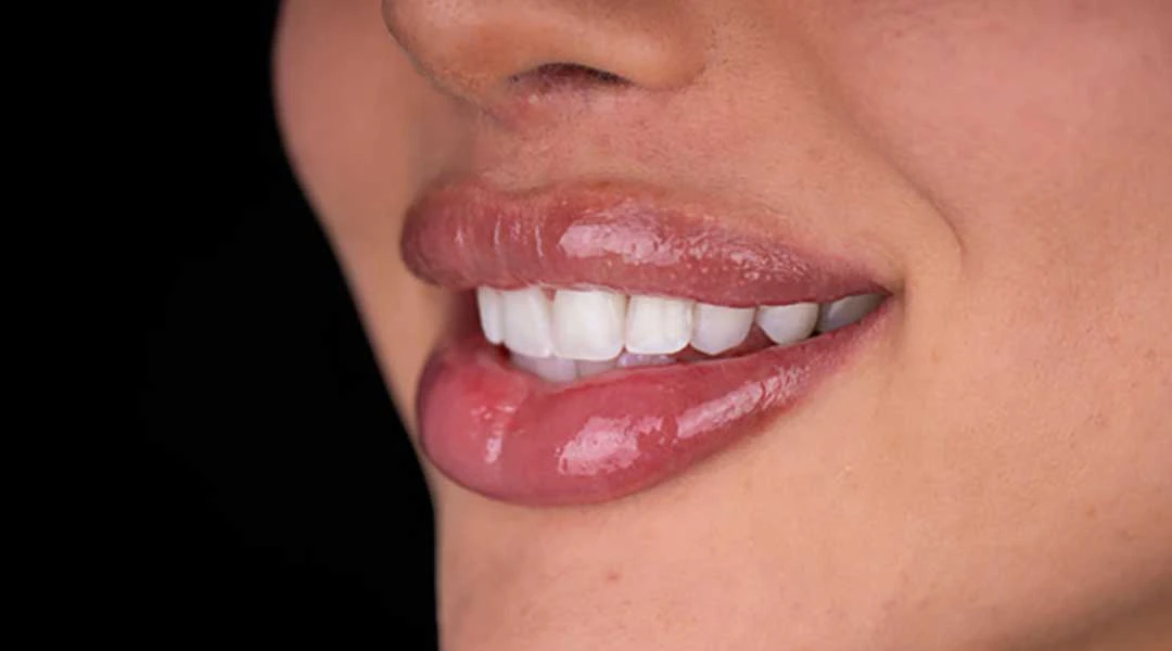 After in-office teeth whitening and Guided Biofilm Therapy