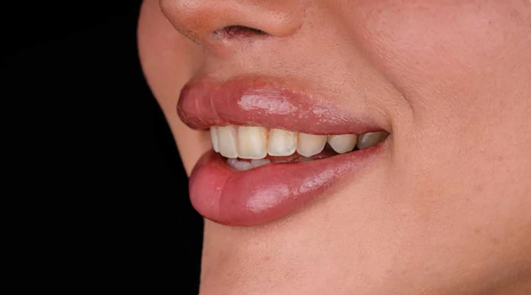 Before in-office teeth whitening and Guided Biofilm Therapy