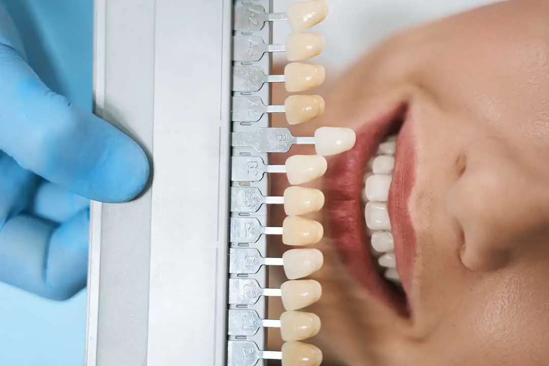 In-Office Teeth Whitening: Essential Aftercare Tips