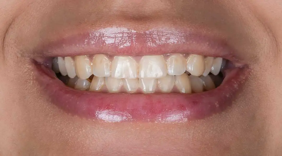 Before Guided Biofilm Therapy & Whitening Treatment