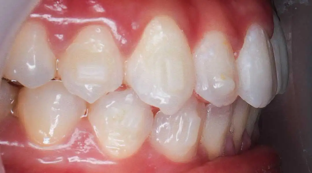 Photo showing teeth of a patient after braces treatment with Dr. Karam Kharsa