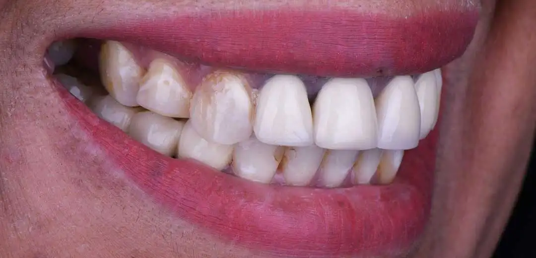 Before veneers treatment