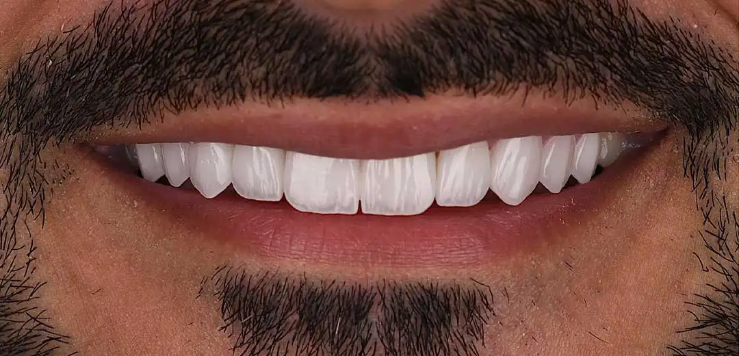 Close-up of a male patient’s new smile refreshed with natural looking and evenly shaped veneers by Dr. Roula Kilani at Harmony Medical Center in Dubai