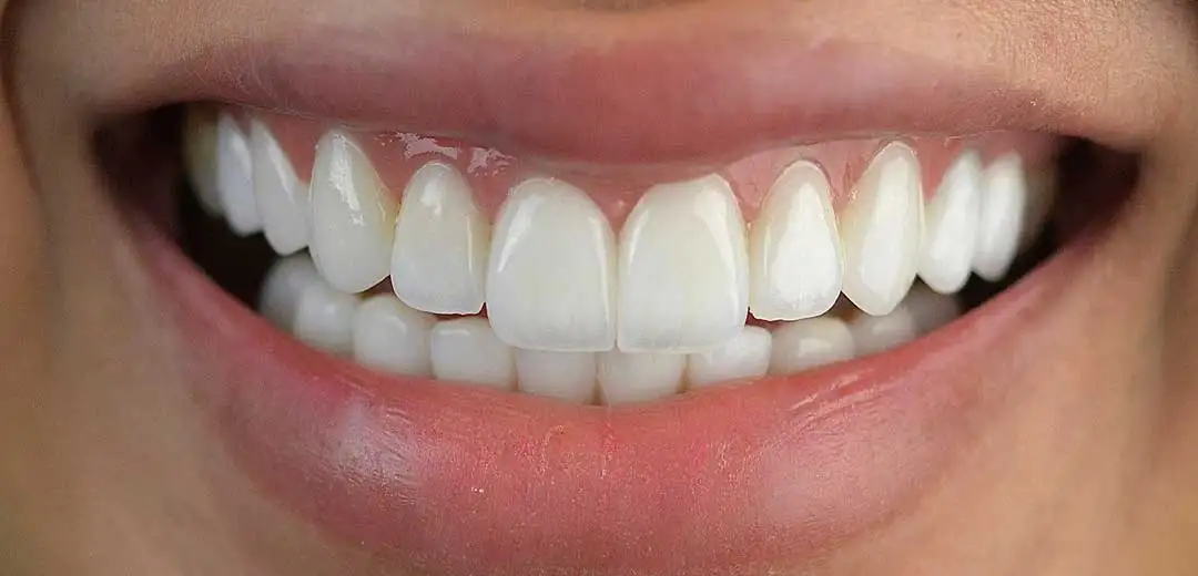 Close-up of a female patient’s new smile refreshed with natural looking and evenly shaped veneers by Dr. Roula Kilani at Harmony Medical Center in Dubai
