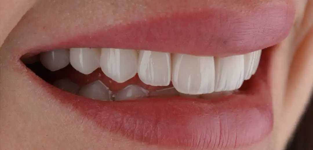 After Hollywood Smile Makeover at Harmony Medical Center