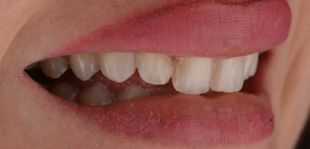 Before Hollywood Smile Makeover at Harmony Medical Center