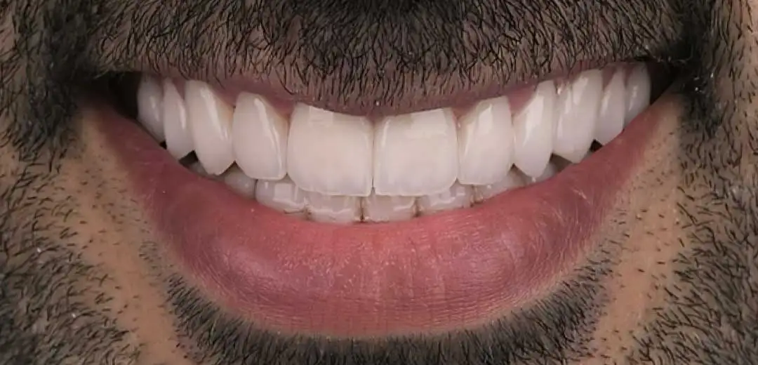 After Hollywood Smile Makeover at Harmony Medical Center