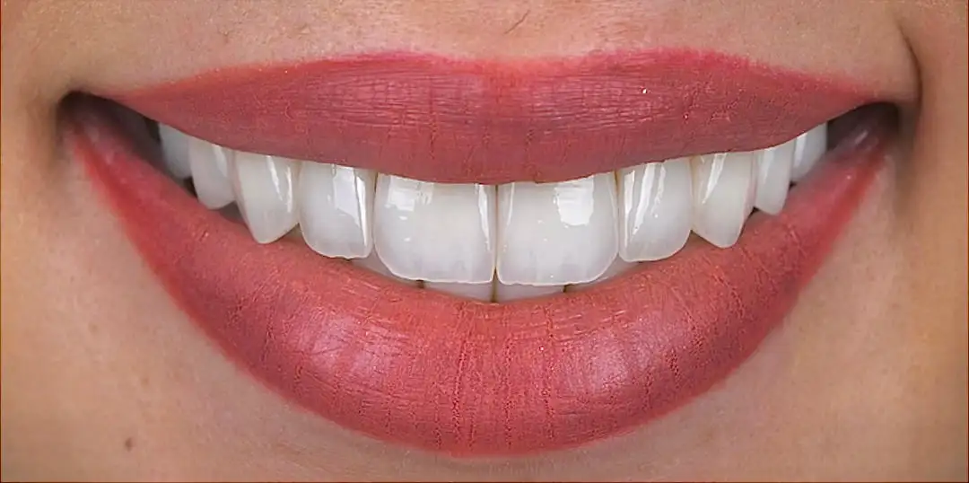 After veneers treatment