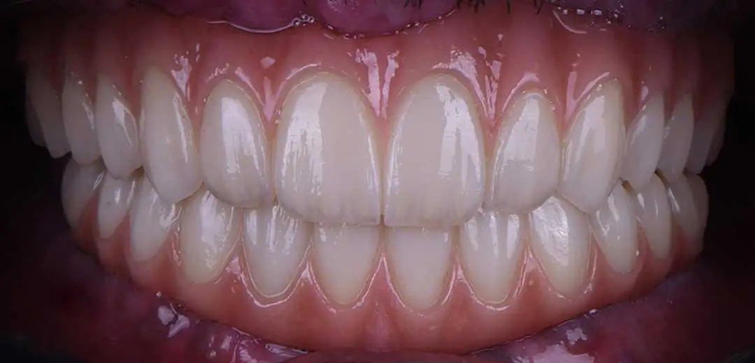 After dental implants