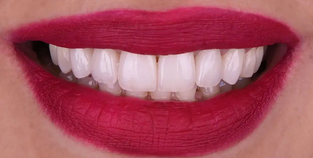 After Hollywood Smile Makeover at Harmony Medical Center