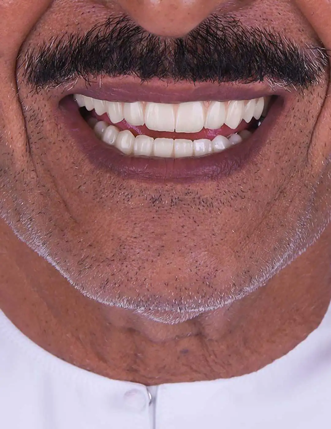 Close-up of the smile of an elderly Emirati patient at Harmony Medical Center after All-on-4 dental implant treatment.