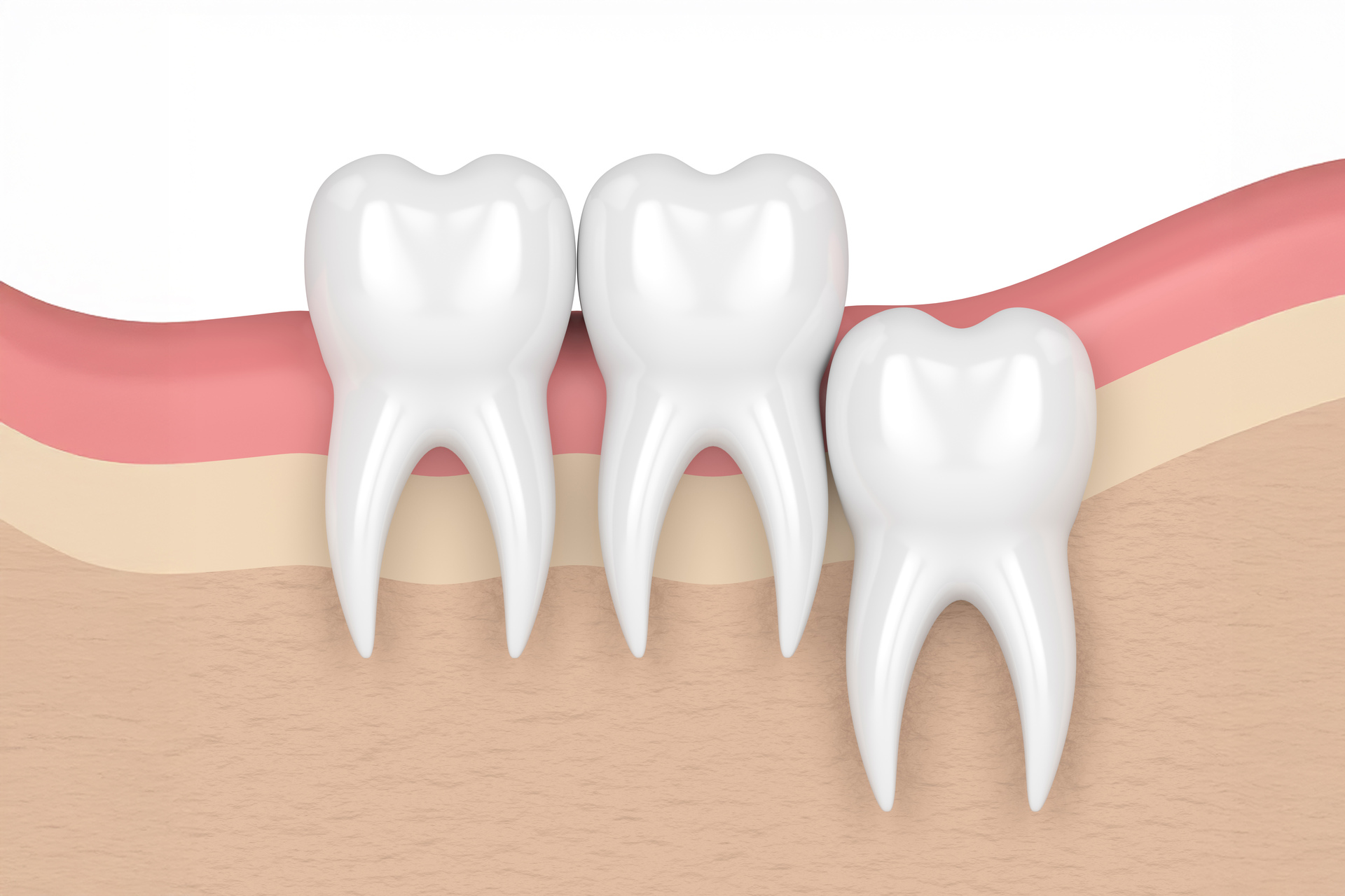 Does Everyone Have Wisdom Teeth? A Comprehensive Guide