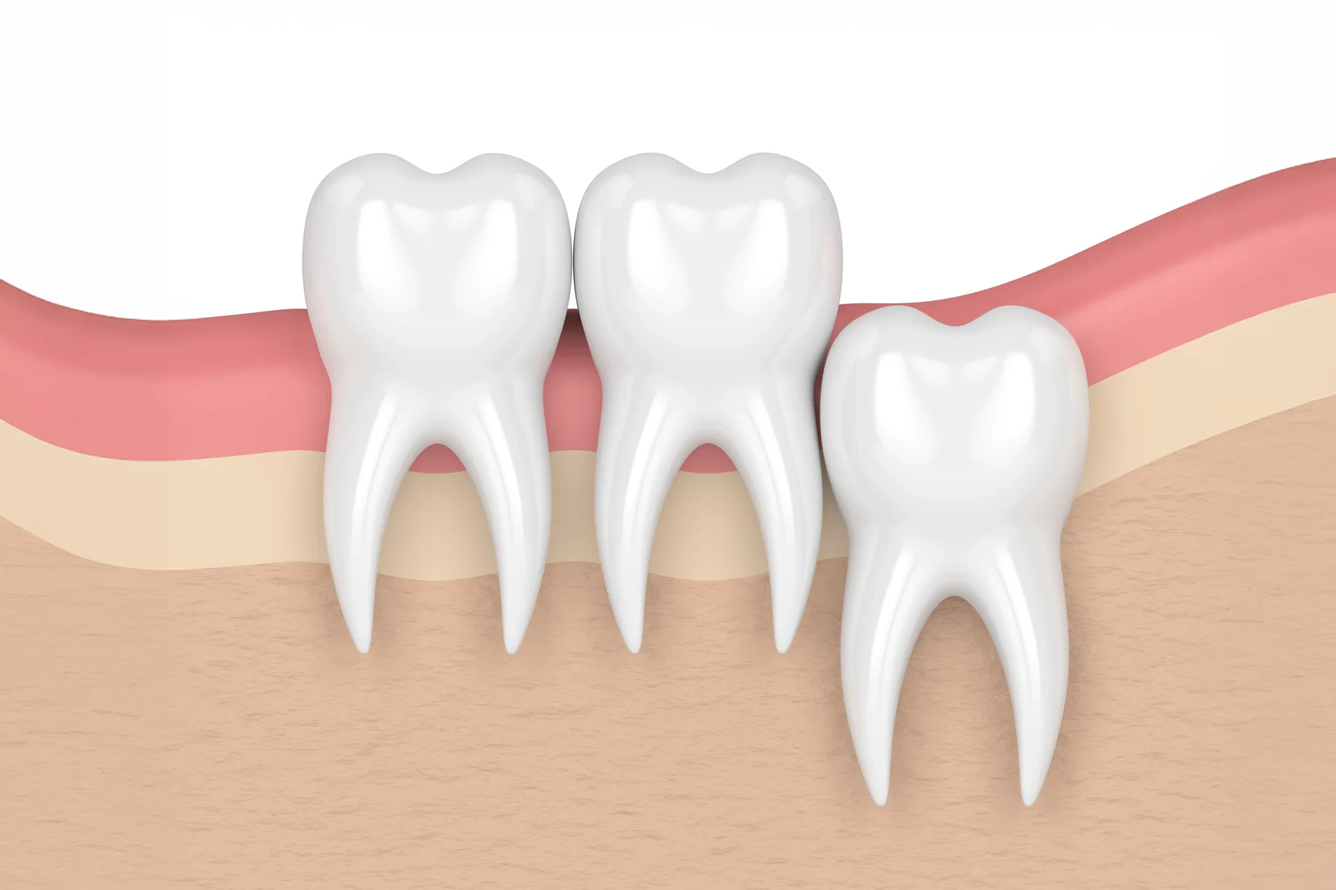 Does Everyone Have Wisdom Teeth? A Comprehensive Guide
