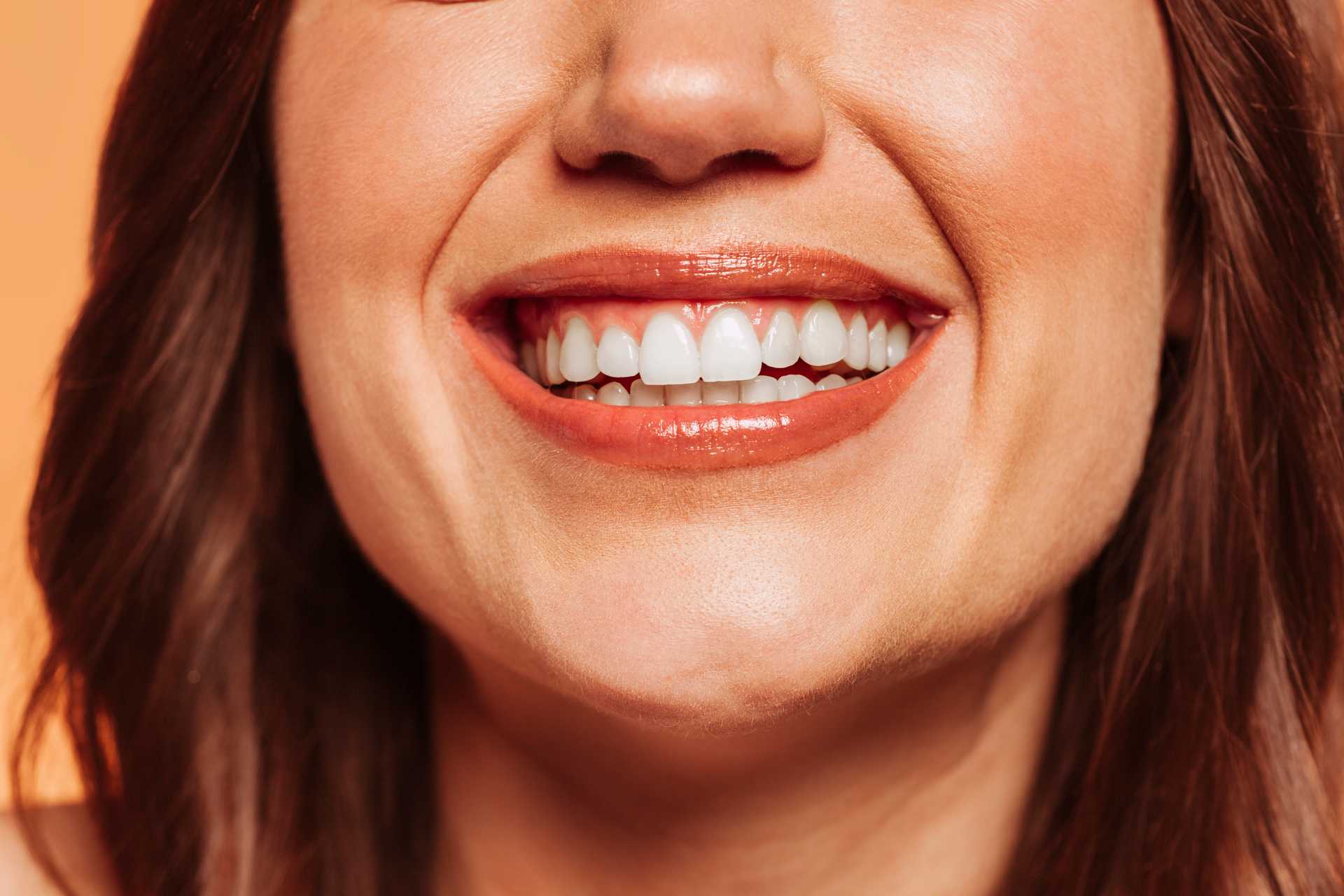 What Is Composite Bonding? - Composite Bonding Near Me
