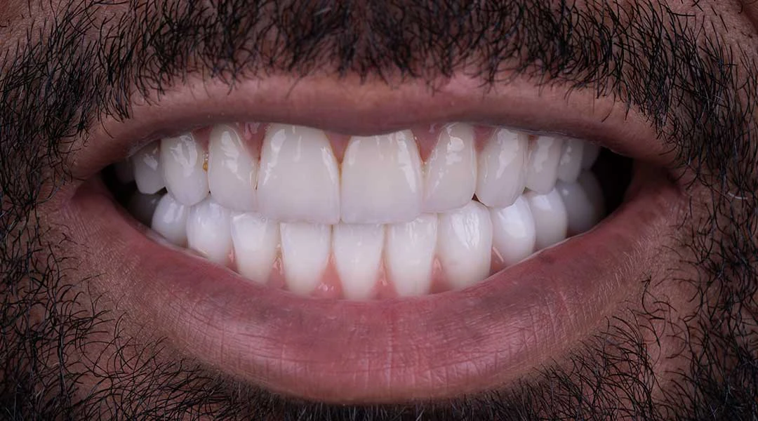 full mouth rehabilitation abu dhabi