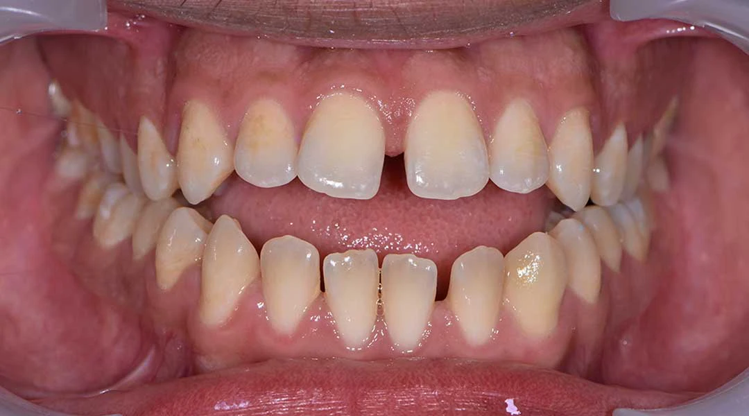 Before Invisalign Treatment