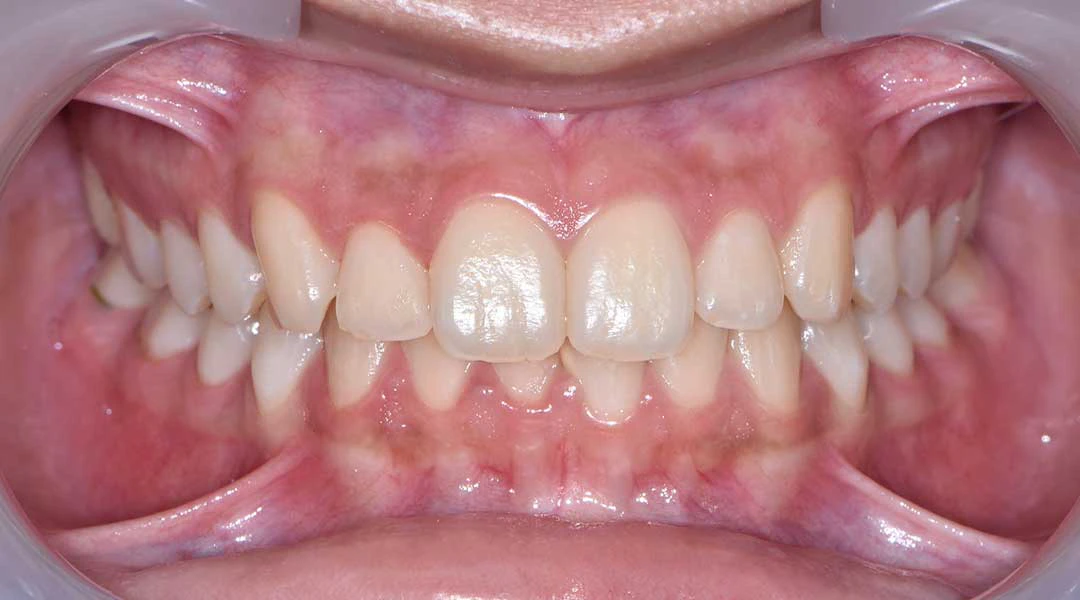Invisalign in Dubai - Harmony Medical Center Jumeriah, Dubai