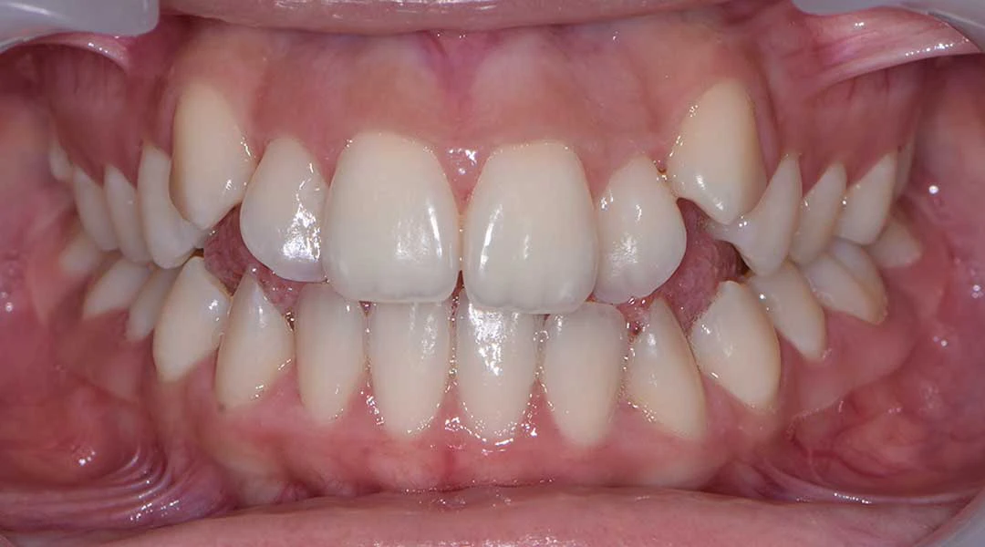Invisalign in Dubai - Harmony Medical Center Jumeriah, Dubai