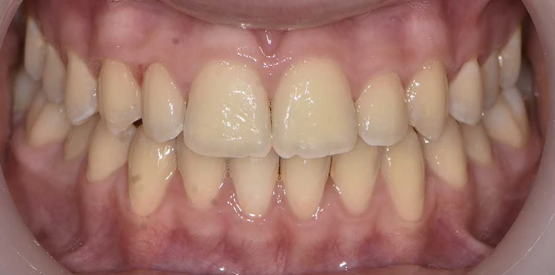 Invisalign dubai