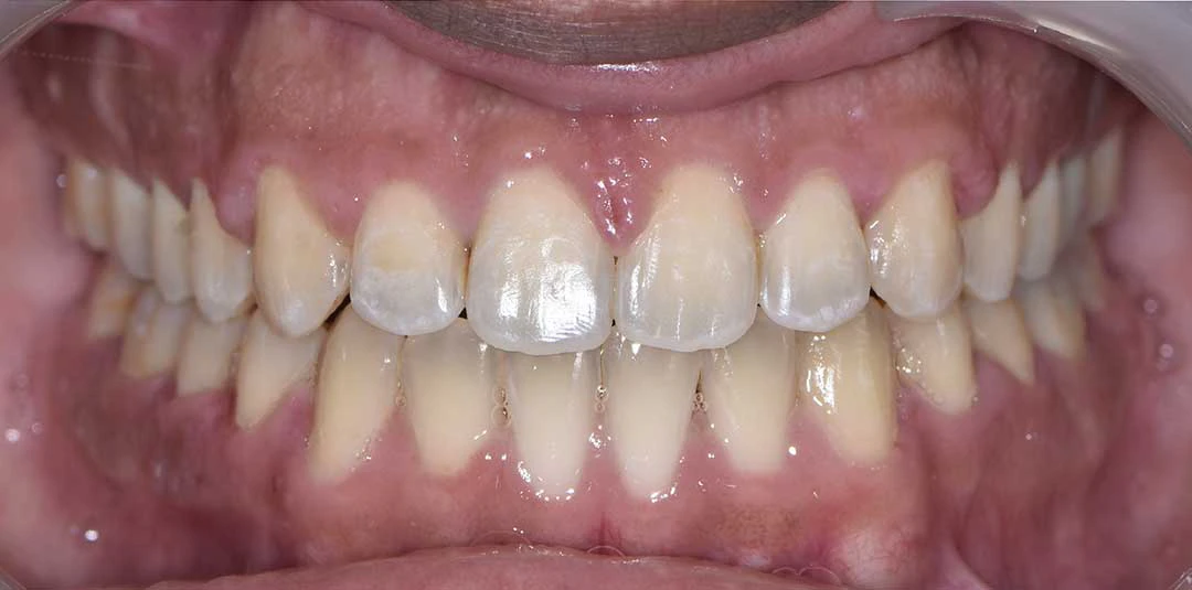 Invisalign in Dubai - Harmony Medical Center Jumeriah, Dubai