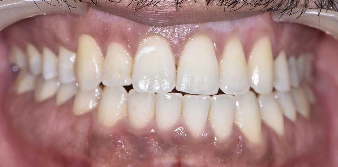 Invisalign Treatment in Dubai