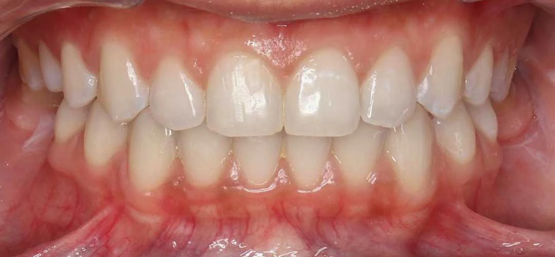 Photo showing front teeth of a patient after braces treatment with Dr. Karam Kharsa